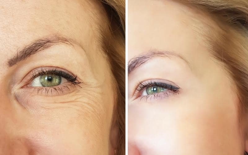 Carbossiterapia per circolazione e ossigenazione tessuti